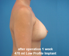 plastic-surgery-breast-augmentation